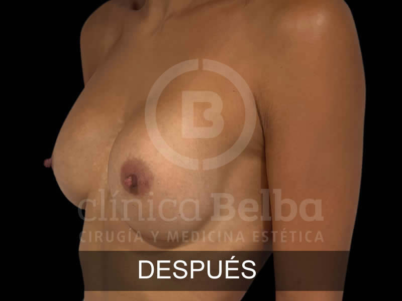 belba-aumento-armonia-6-despues