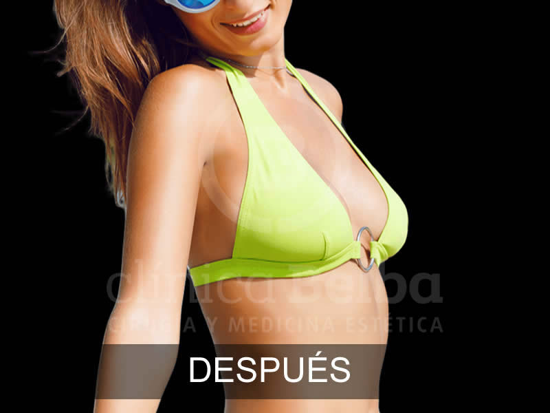 belba-aumento-armonia-7-despues-e