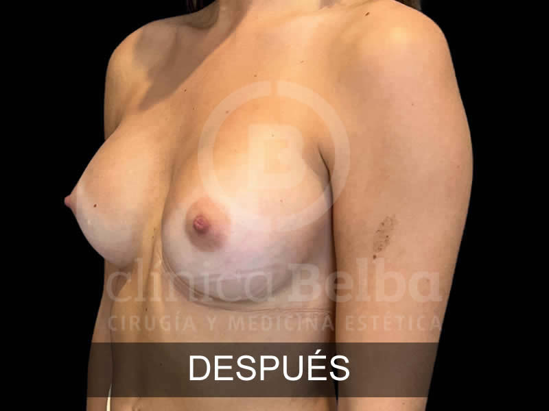 belba-aumento-armonia-7-despues