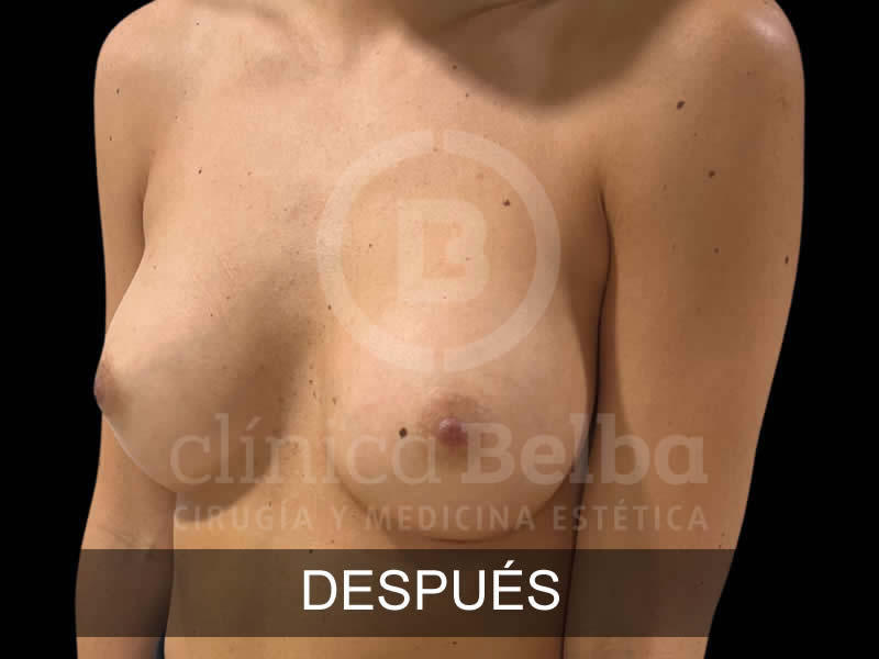 belba-aumento-armonia-8-despues