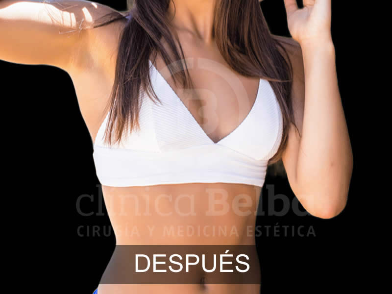 belba-aumento-elegance-2-despues-e