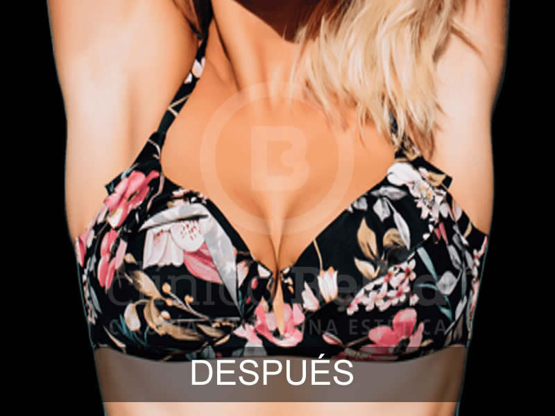 belba-aumento-elegance-3-despues-e