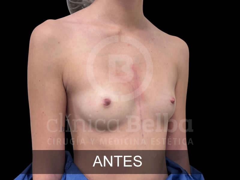 belba-aumento-elegance-5-antes