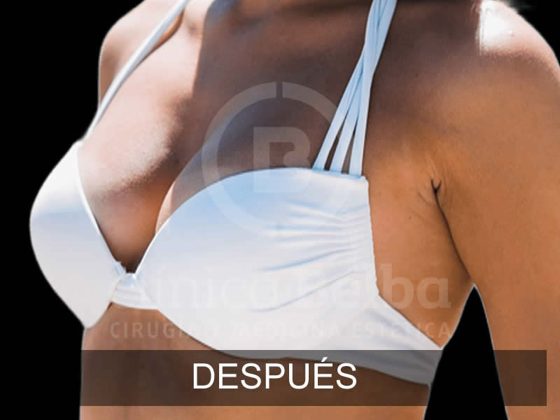 belba-aumento-elegance-5-despues-e