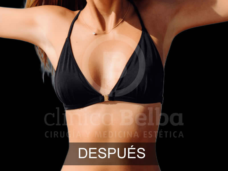 belba-aumento-elegance-6-despues-e