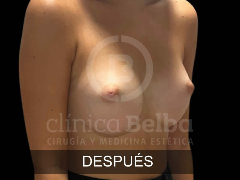 belba-aumento-elegance-8-despues