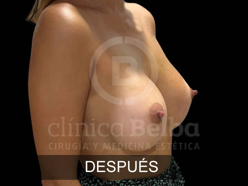 belba-aumento-magnifico-2-despues