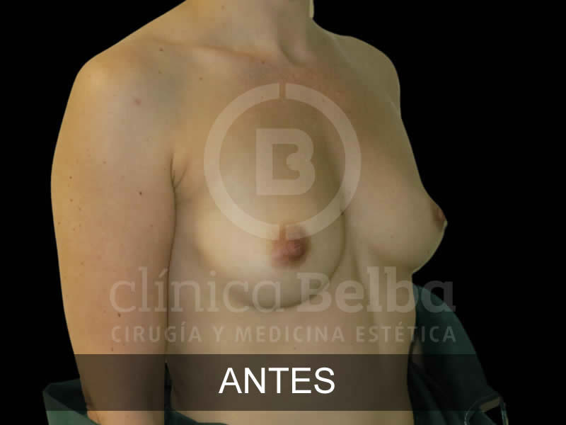 belba-aumento-magnifico-4-antes