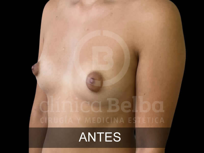belba-aumento-magnifico-6-antes