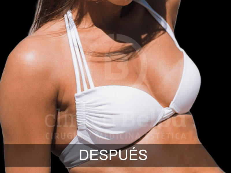 belba-aumento-sublime-1-despues-e