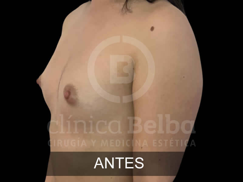 belba-aumento-sublime-10-antes