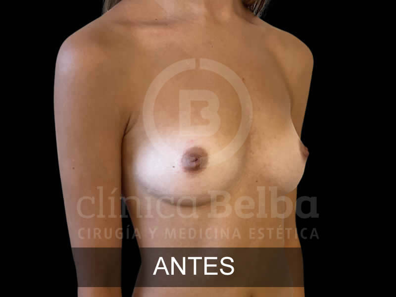 belba-aumento-sublime-11-antes