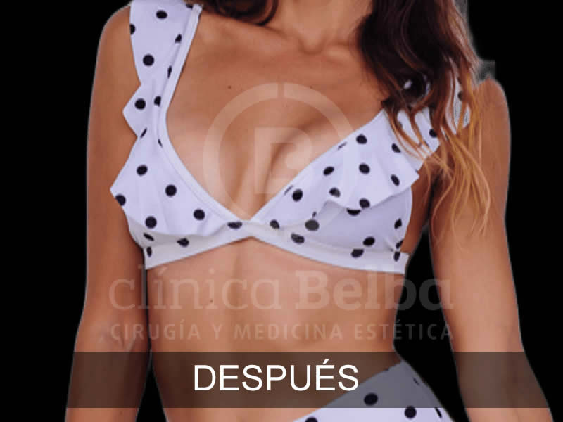 belba-aumento-sublime-11-despues-e