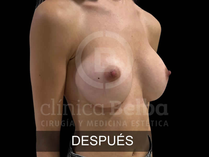belba-aumento-sublime-11-despues
