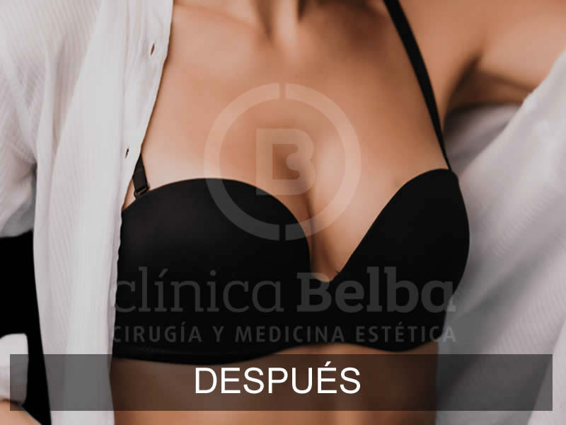 belba-aumento-sublime-12-despues-e