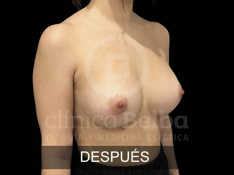 belba-aumento-sublime-12-despues