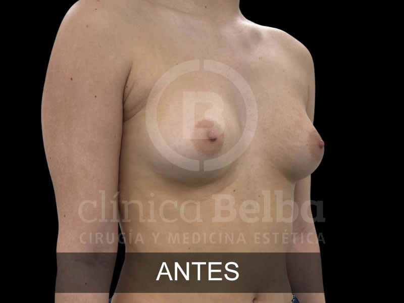 belba-aumento-sublime-2-antes