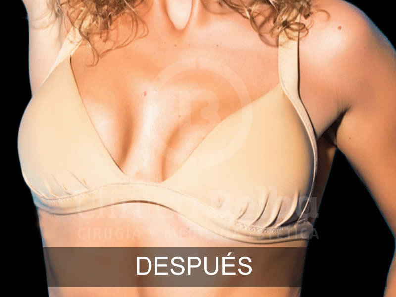 belba-aumento-sublime-2-despues-e