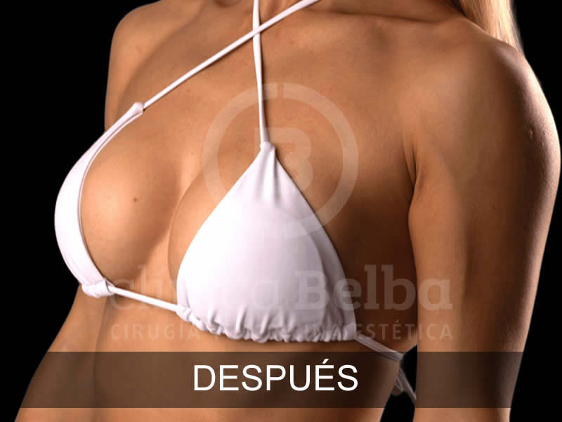 tipos de aumento de pecho