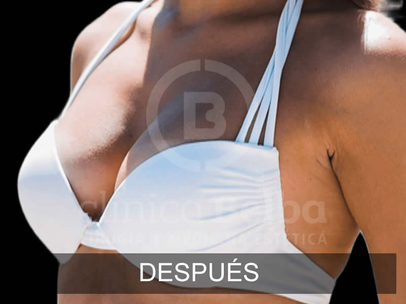 belba-aumento-sublime-5-despues-e