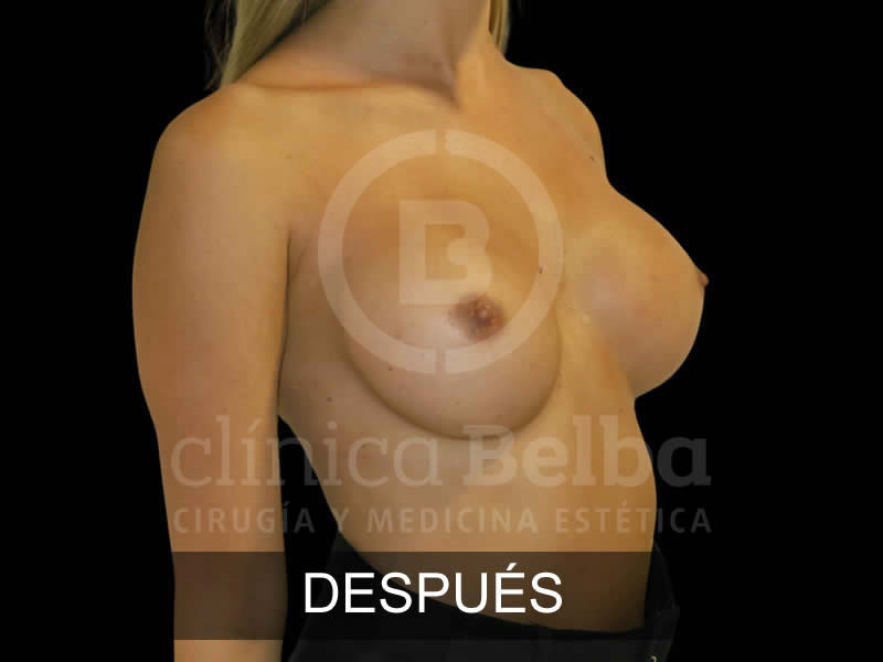 belba-aumento-sublime-6-despues