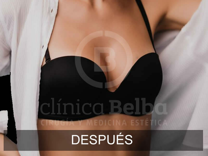 belba-aumento-sutil-1-despues-e