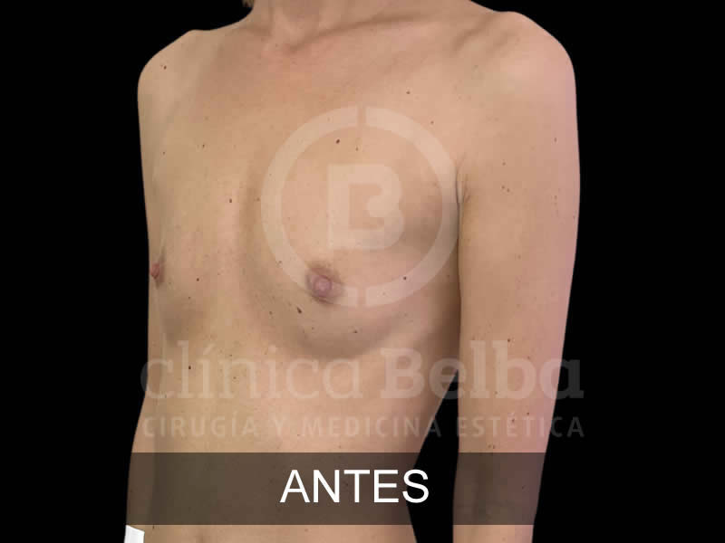 belba-aumento-sutil-2-antes