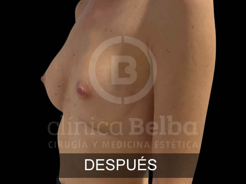 belba-aumento-sutil-2-despues