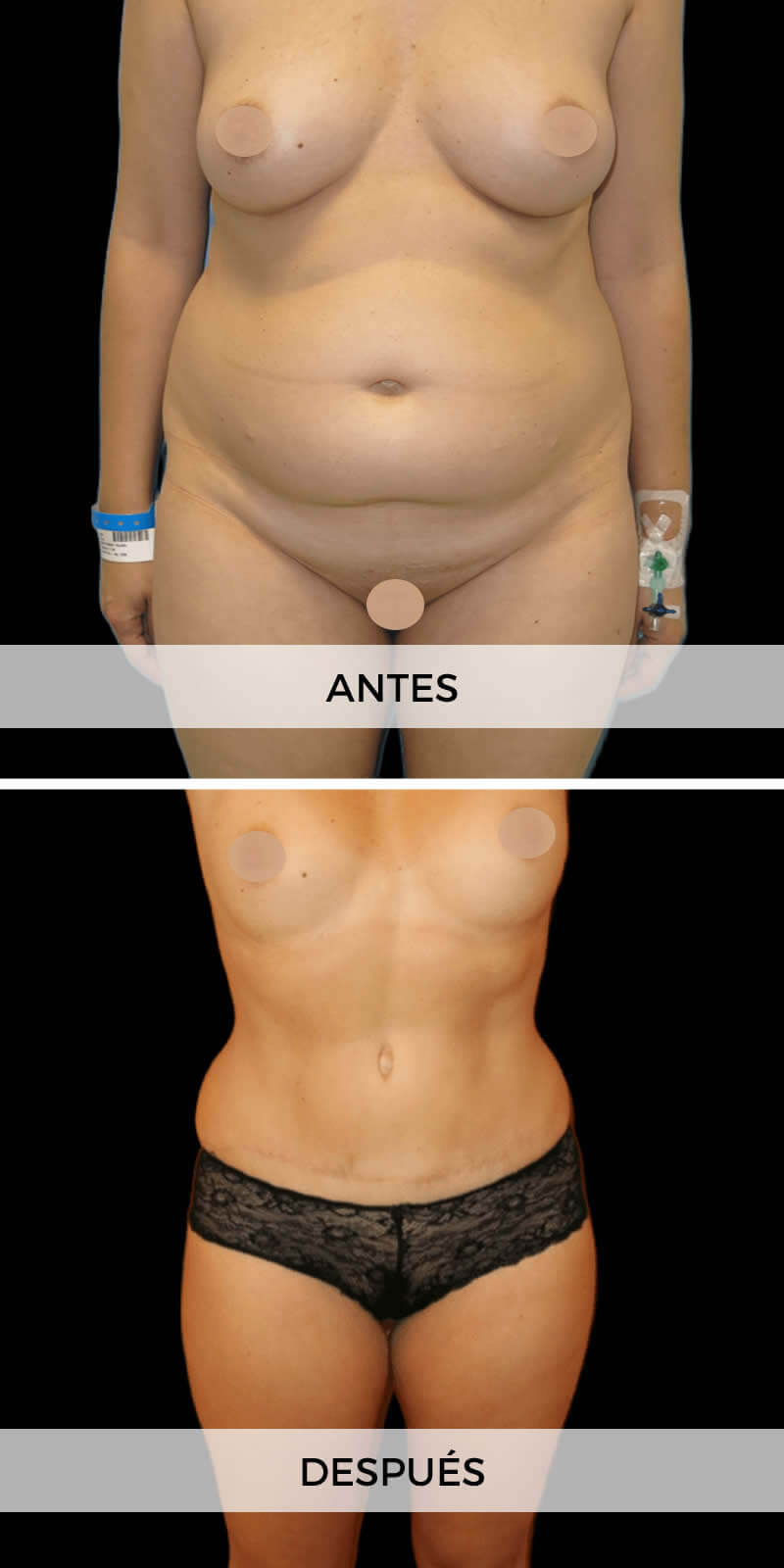 foto-abdominoplastia-antes-despues-1