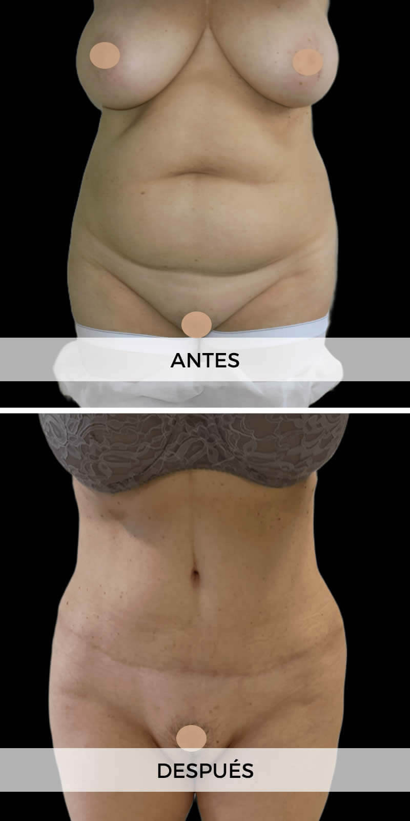 foto-abdominoplastia-antes-despues-3
