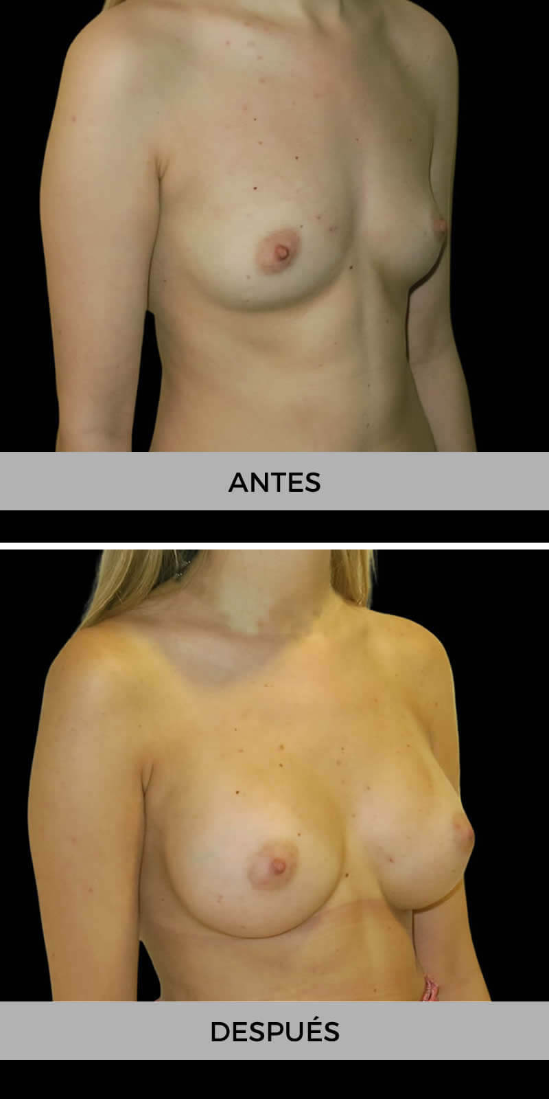 foto-aumento-pecho-antes-despues-2