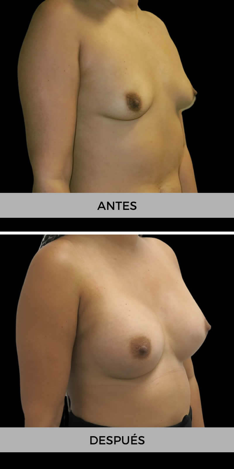 foto-aumento-pecho-antes-despues-4