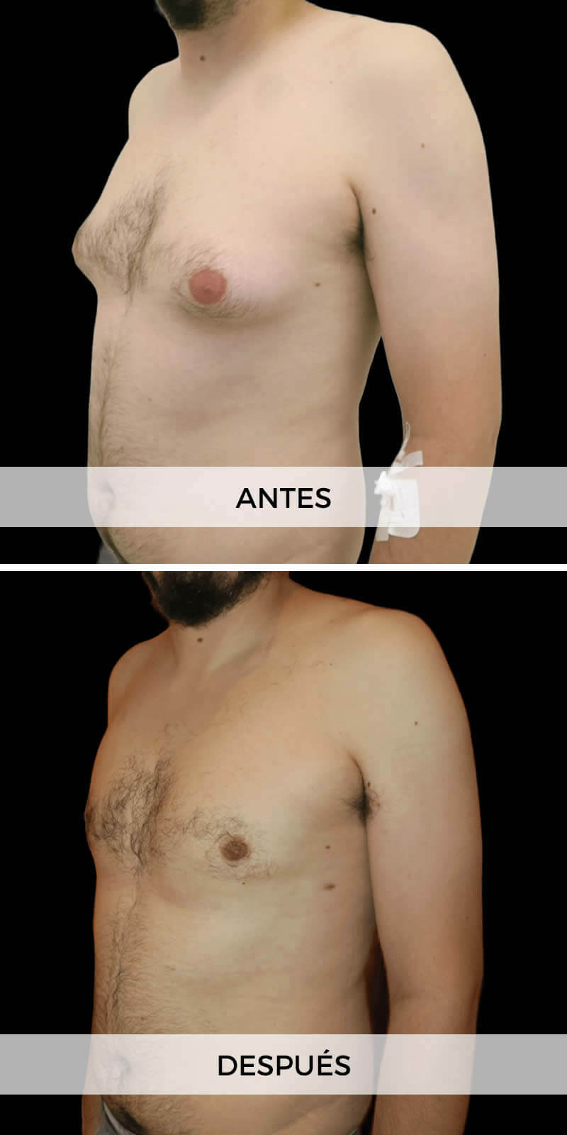 foto-ginecomastia-antes-despues-2