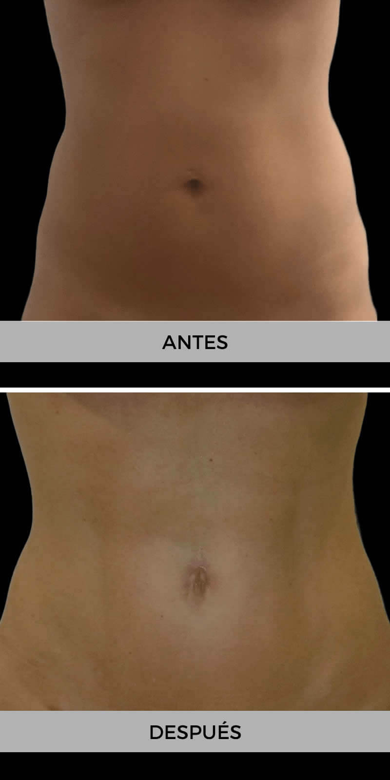 foto-liposuccion-antes-despues-2