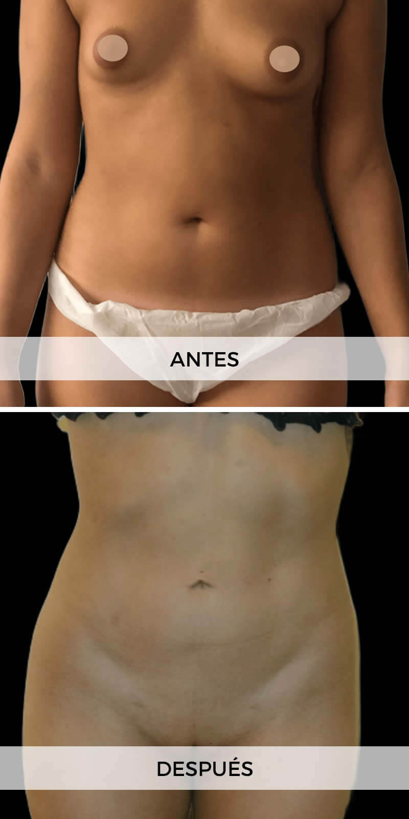 foto-liposuccion-antes-despues-4