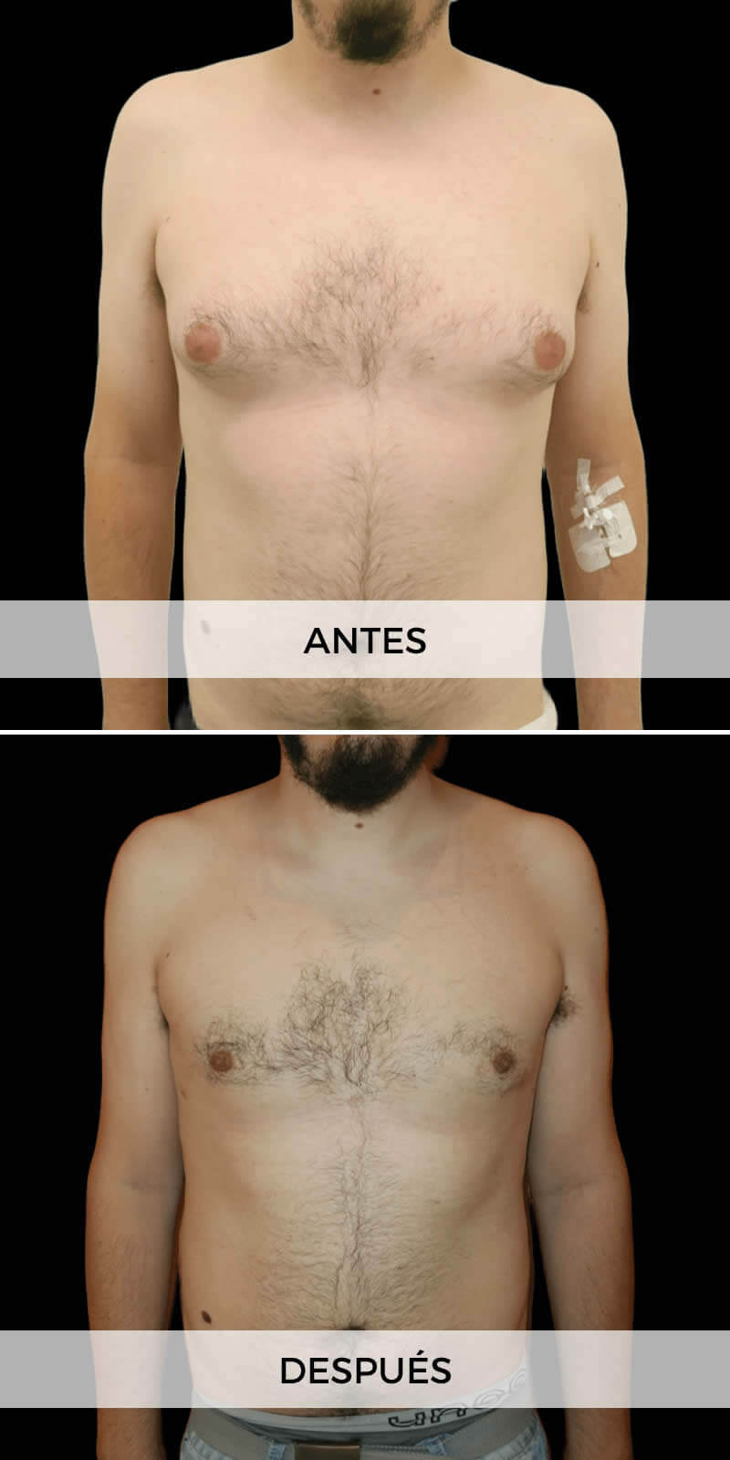 ginecomastia-antes-despues-01