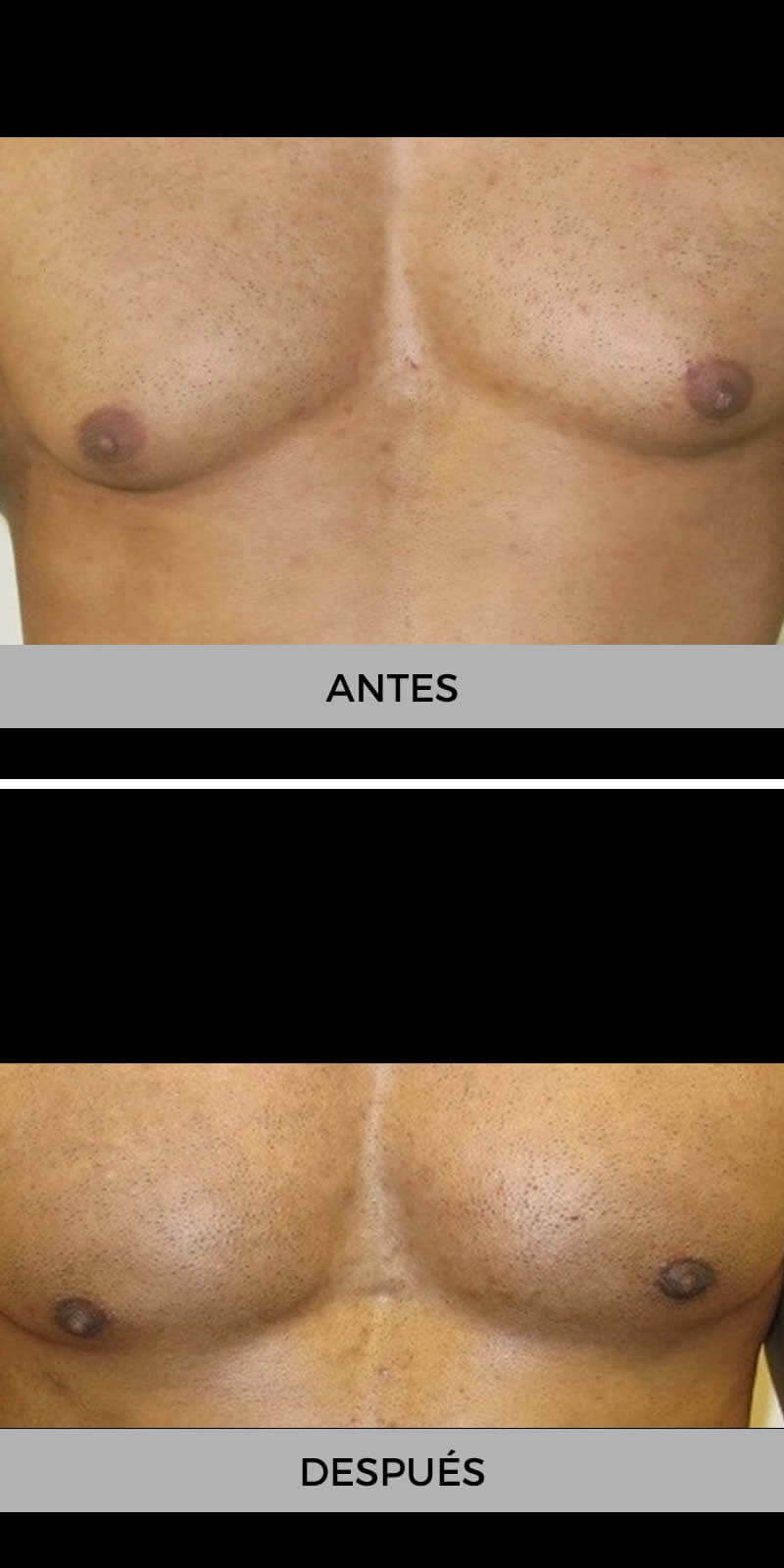 ginecomastia-antes-despues-3
