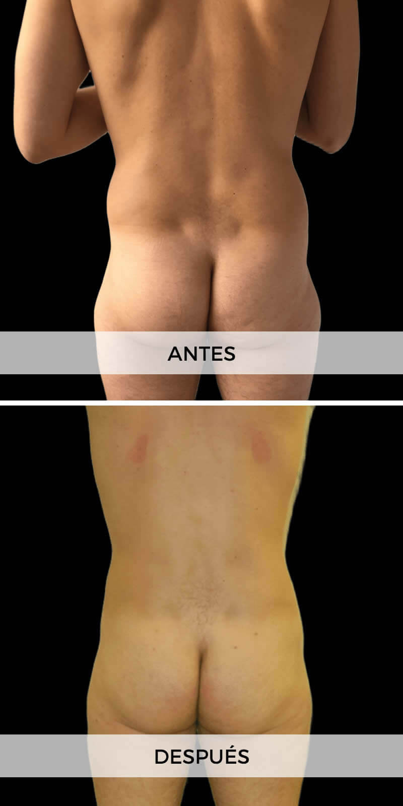 liposuccion-antes-despues-1