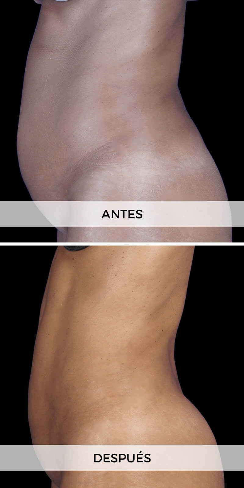liposuccion-antes-despues-3