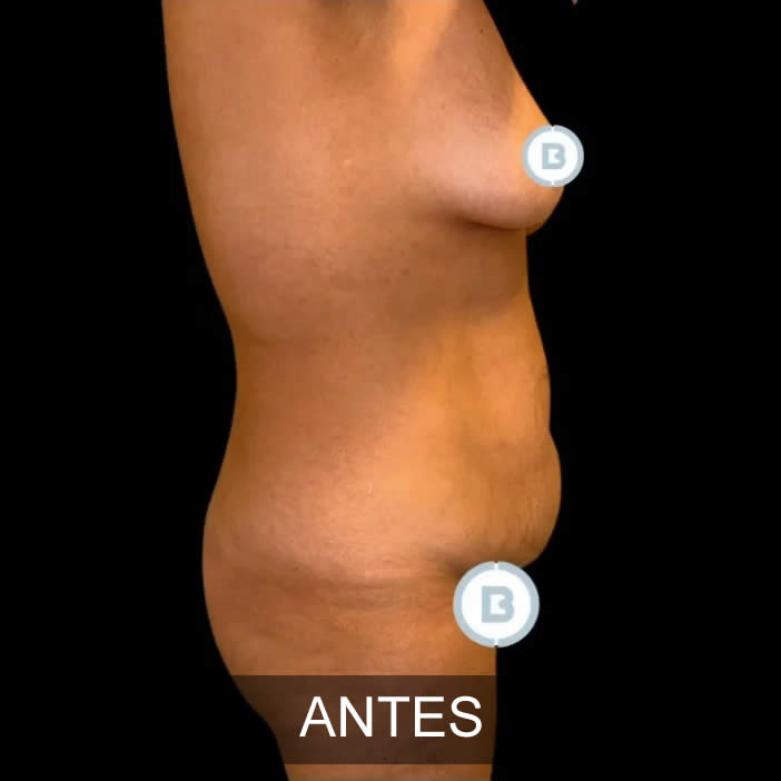 mommy makeover antes despues