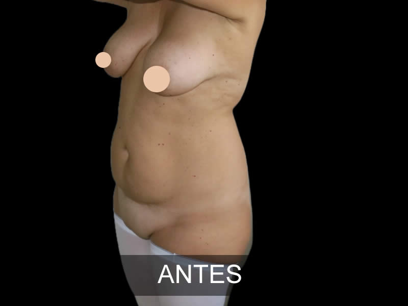 mommy makeover antes y después