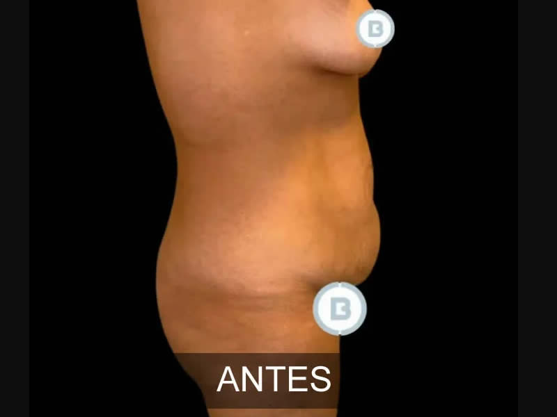 mommy makeover antes y después