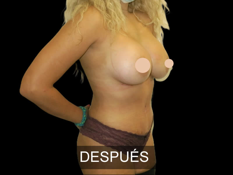 mommy makeover antes y después