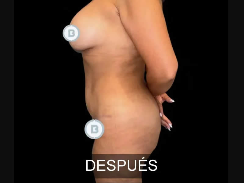 mommy makeover antes y después