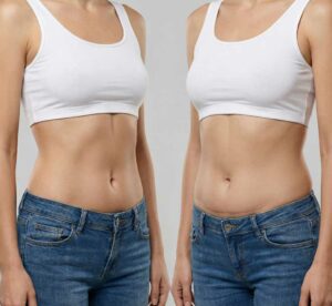 Abdominoplastia-o-liposucción-