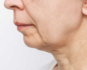 Resultados del lifting facial