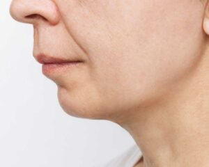 Resultados del lifting facial