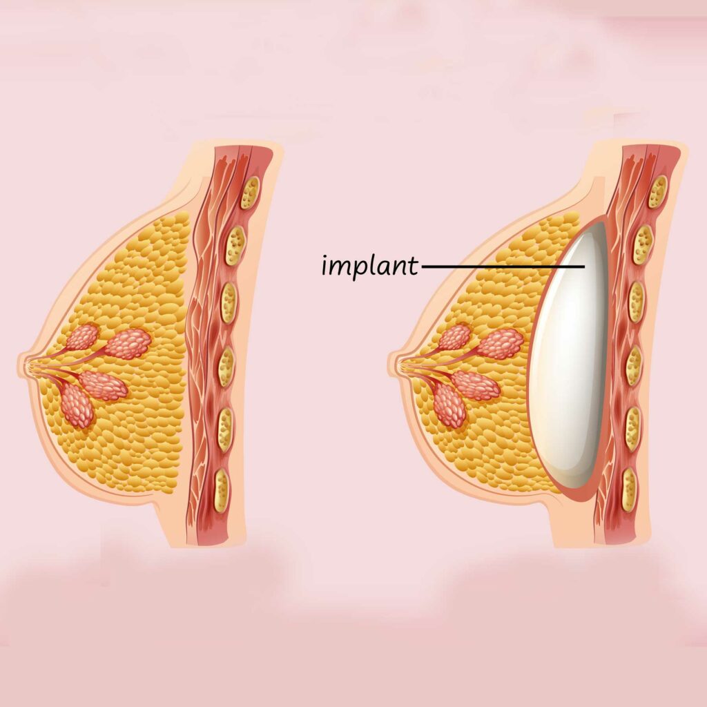 Aumento-híbrido-vs-implantes-comparación-rápida