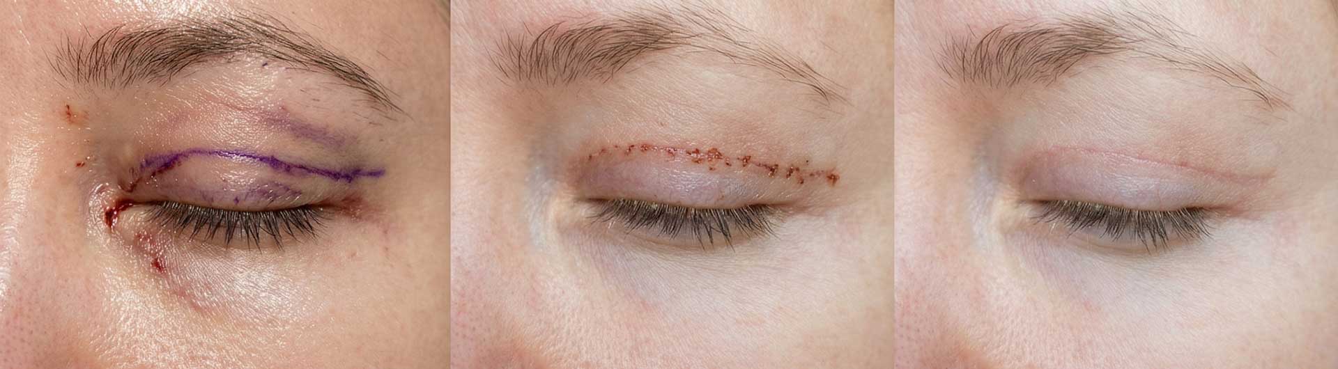 Cómo-evolucionan-la-inflamación-y-las-cicatrices