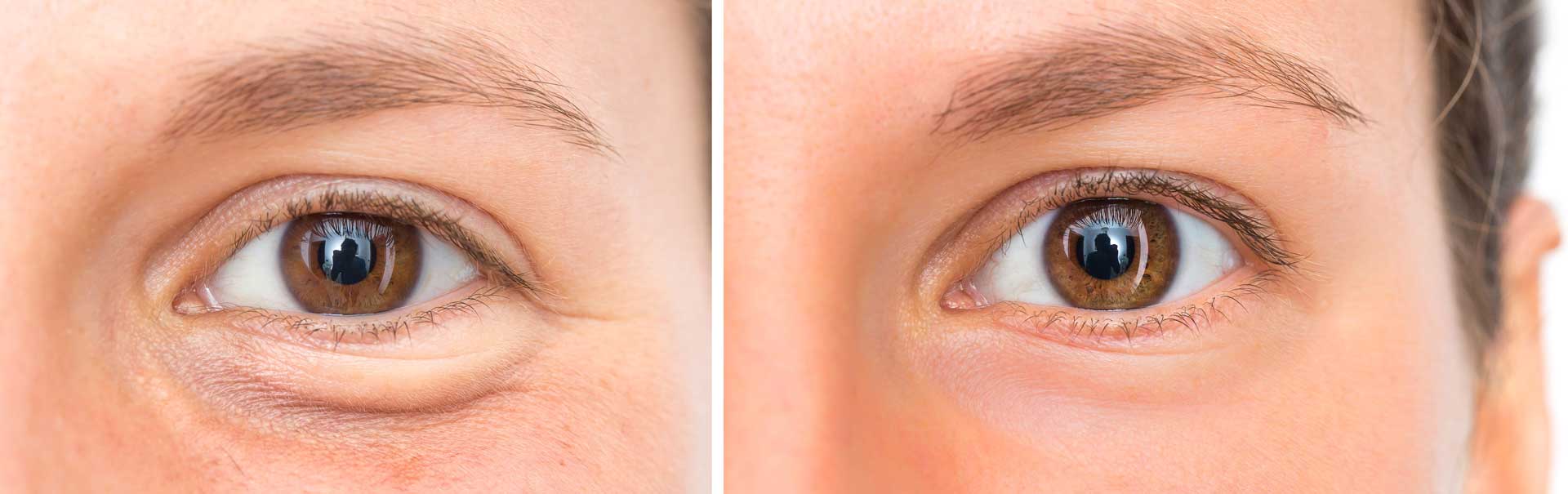 resultados finales de la blefaroplastia